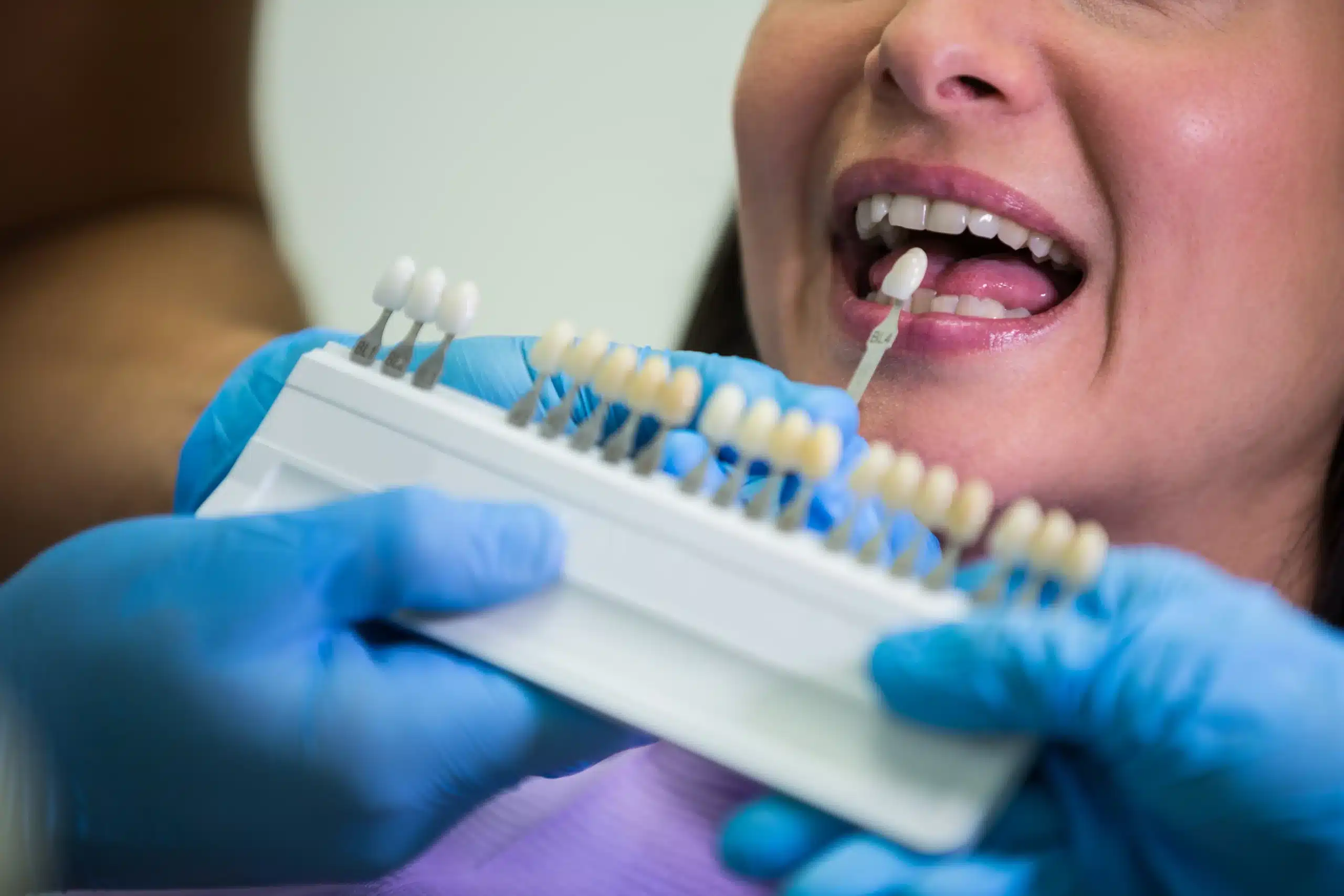 Tooth Implants in Tijuana, Mexico 14 Close-up of a patient undergoing tooth shade matching for natural-looking dental implants in Tijuana.