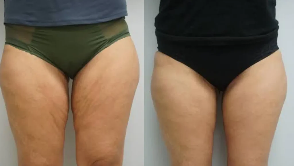 Thigh Lift in Tijuana, Mexico 14 Thigh lift before and after results in Tijuana showing skin tightening and improved leg contour.