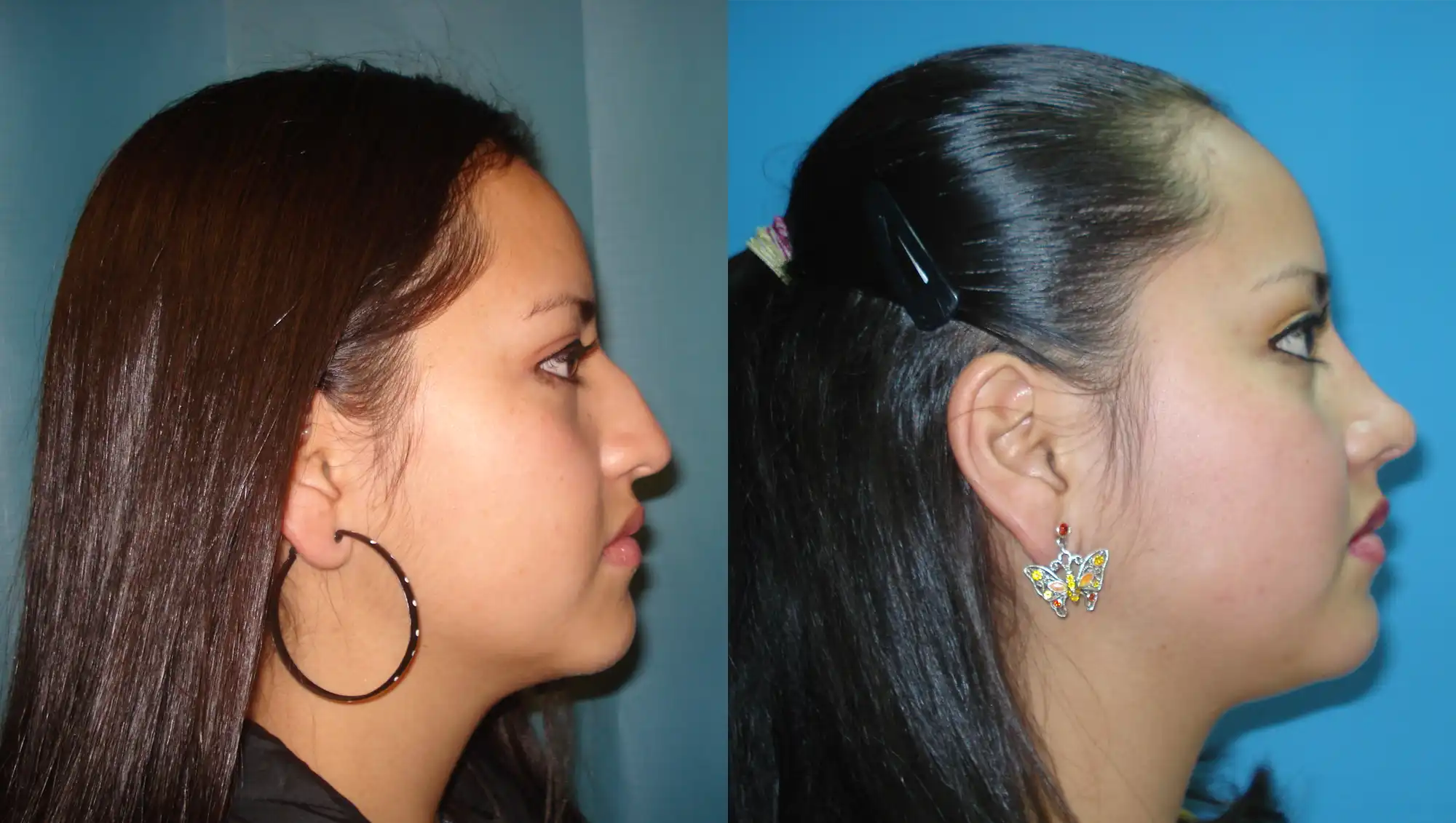 Before and after profile comparison of affordable rhinoplasty surgery in Mexico for a refined nasal bridge.