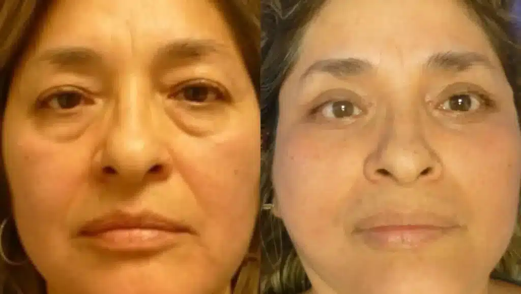 Eyelid Surgery in Tijuana, Mexico 22 Close-up before and after of eyelid surgery in Tijuana showing the correction of under-eye bags and sagging upper lids.