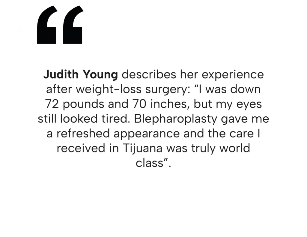 Eyelid Surgery in Tijuana, Mexico 18 Judith Young testimonial on how eyelid surgery in Tijuana gave her a refreshed appearance after major weight loss.