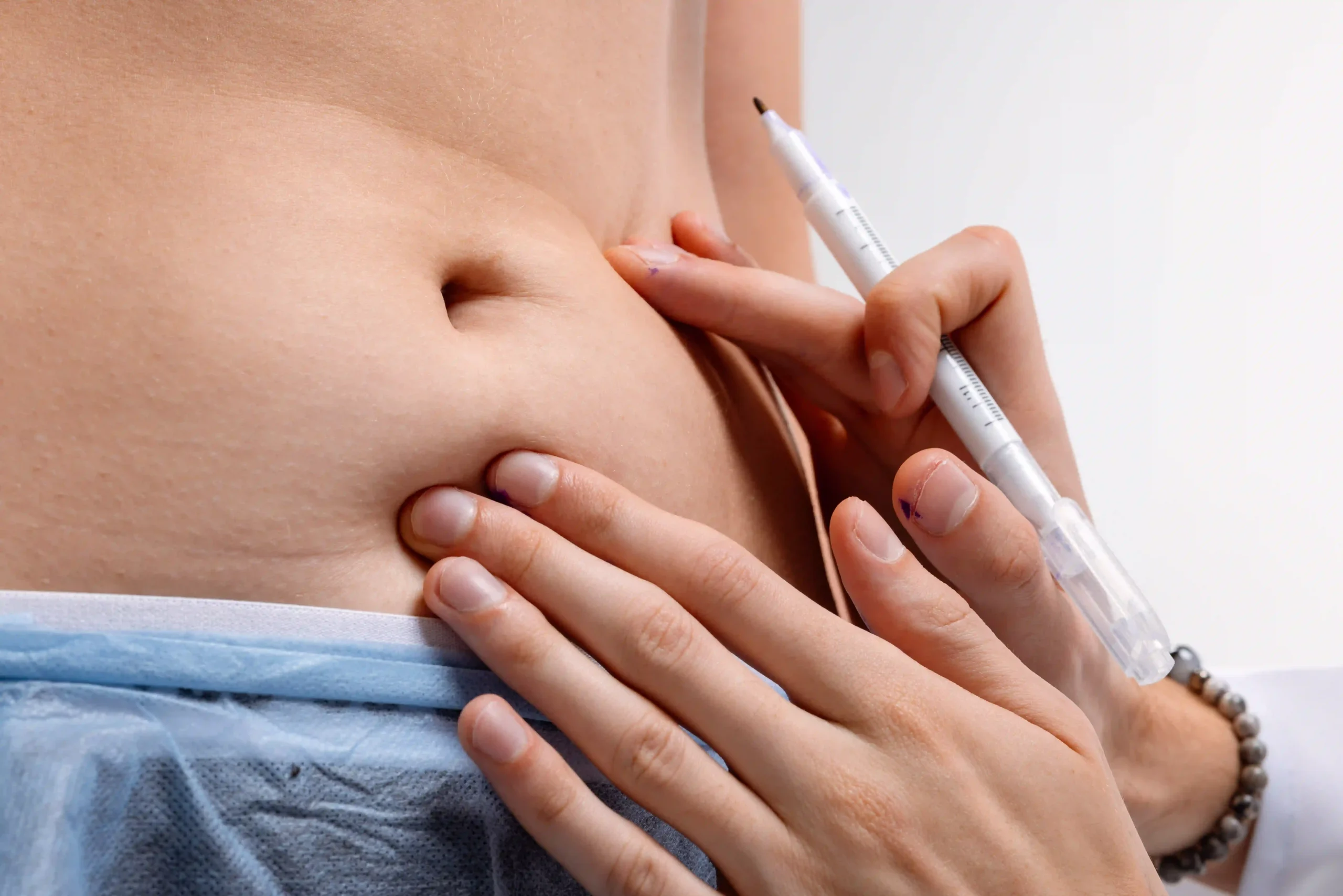 Liposuction in Tijuana, Mexico 11 A board-certified plastic surgeon in Tijuana marking a patient's abdomen for high-definition liposculpture and body contouring.