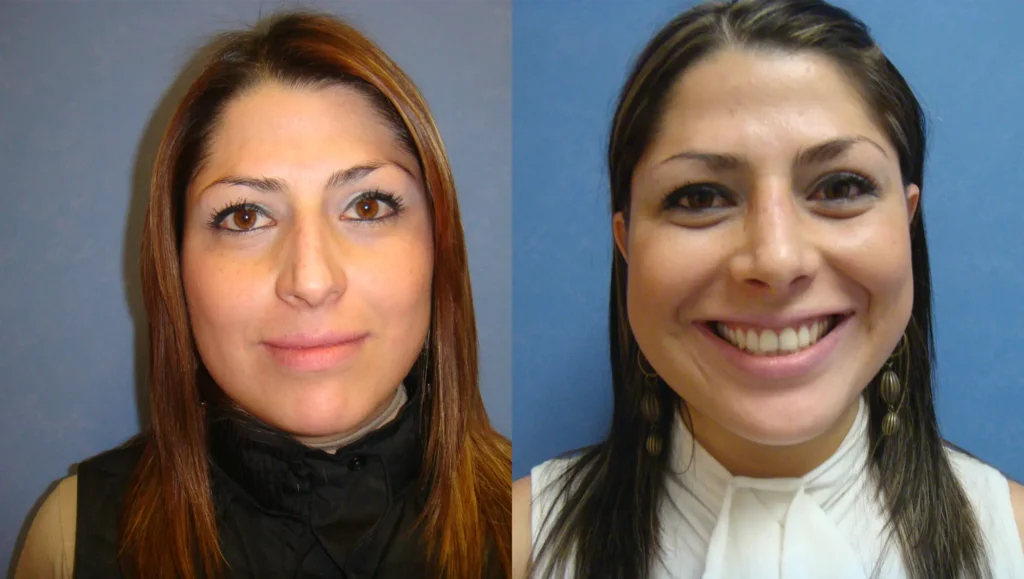 Frontal view results of a successful nose job in Tijuana highlighting improved nasal symmetry and facial balance.
