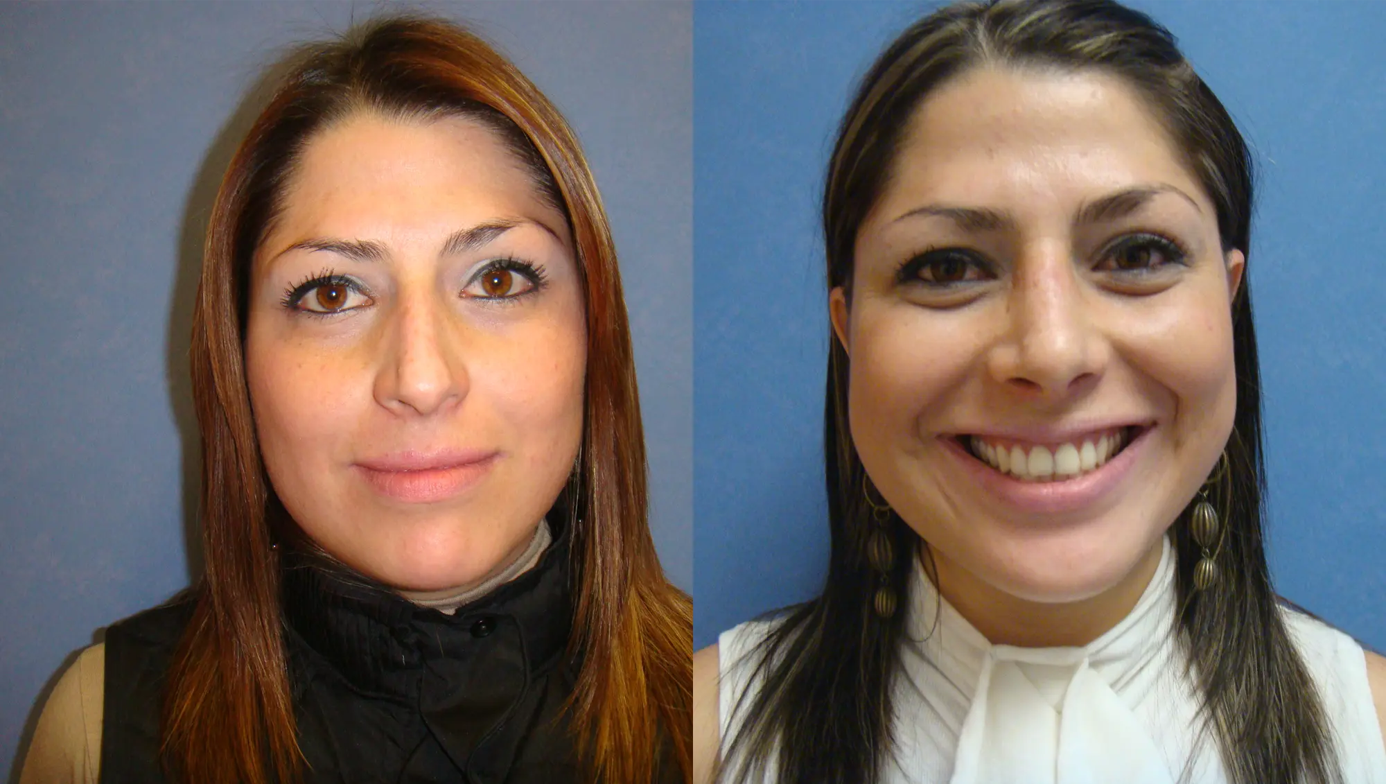 Frontal view results of a successful nose job in Tijuana highlighting improved nasal symmetry and facial balance.