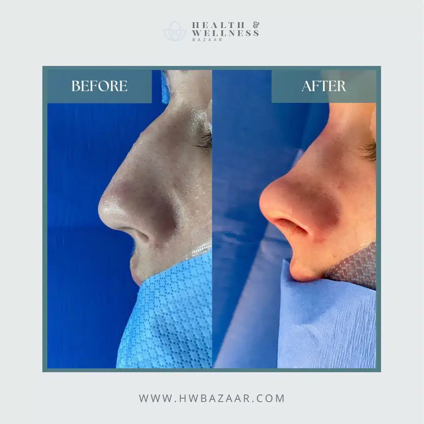 Rhinoplasty Cost in Mexico: What You Will Really Pay and How to Choose Safely 5 Profile view before and after rhinoplasty surgery showing the removal of a dorsal hump and refinement of the nasal tip.