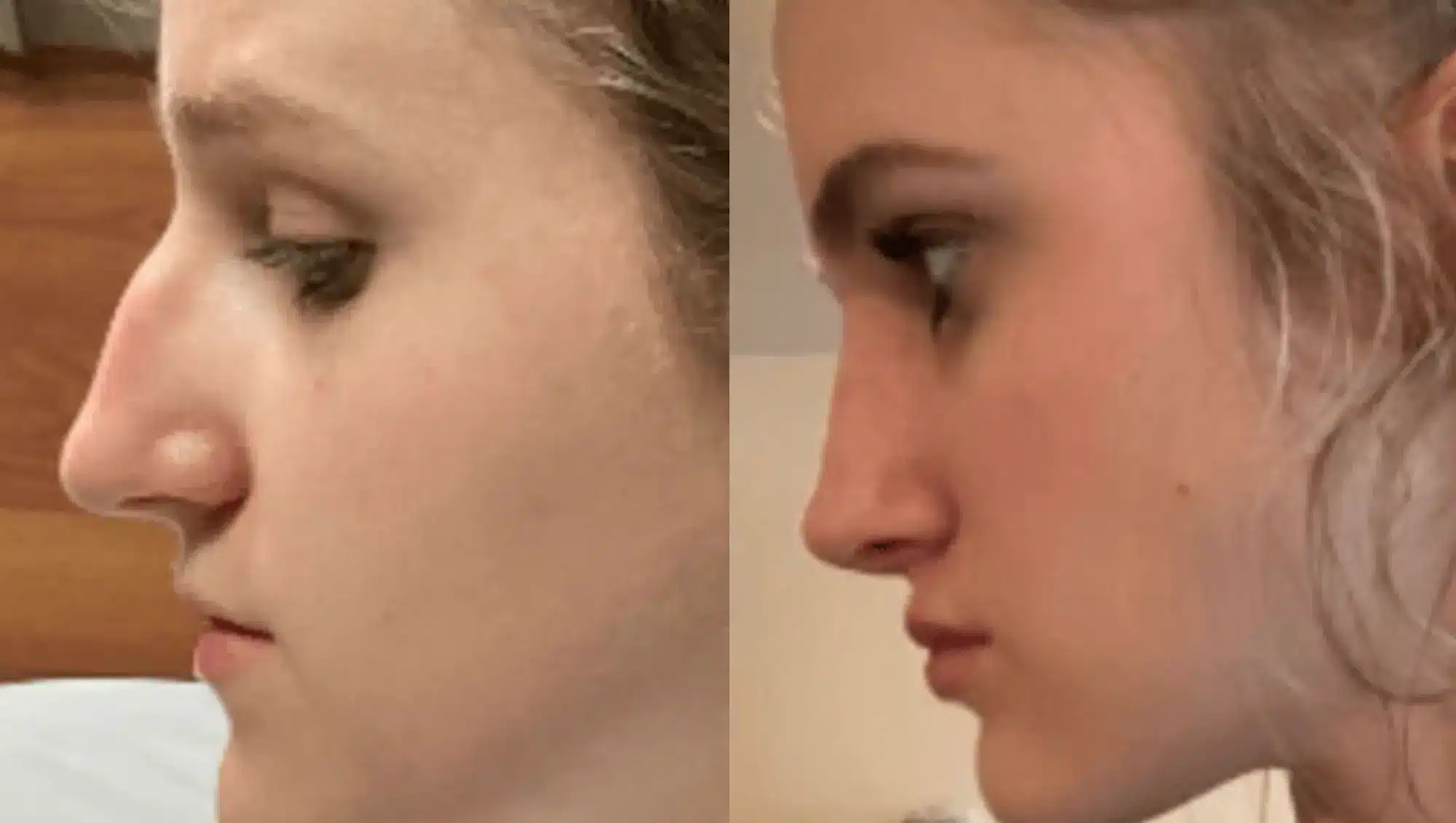 Side profile transformation of a rhinoplasty in Tijuana showing dorsal hump removal and tip refinement.