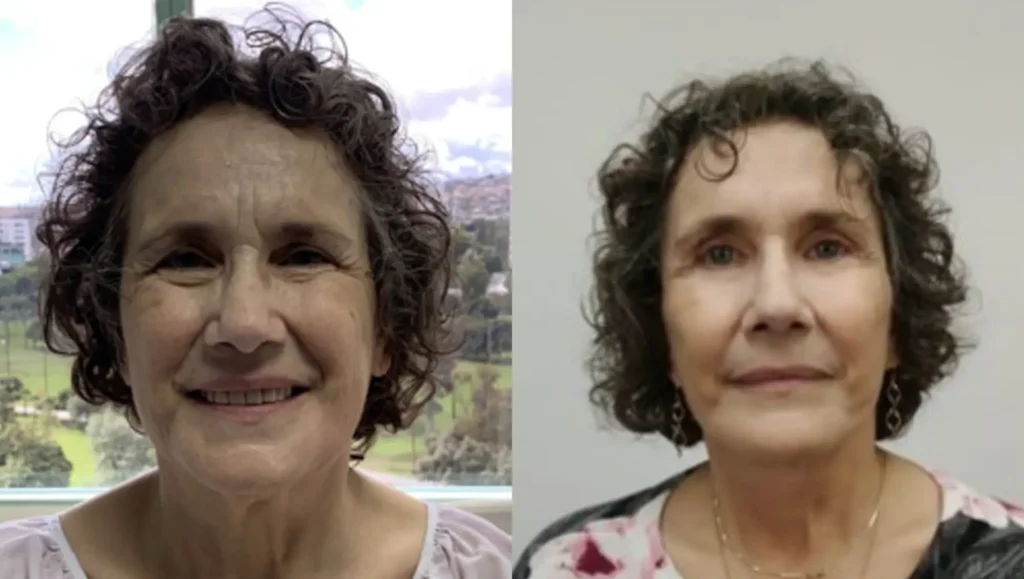 Eyelid Surgery in Tijuana, Mexico 21 Before and after photos of upper and lower blepharoplasty in Tijuana, demonstrating the removal of eye bags and hooded lids.